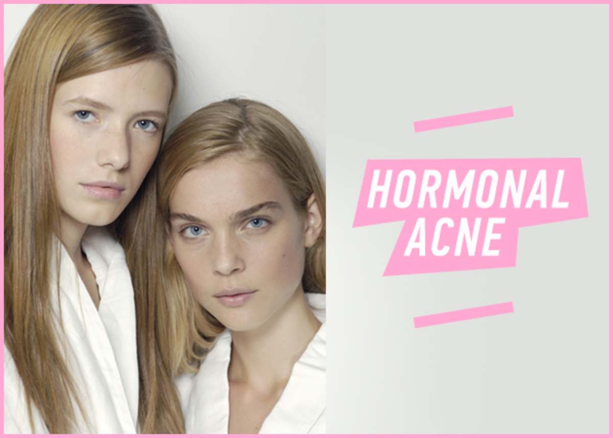 8 πράγματα που πρέπει να ξέρεις για την ακμή στα 30!