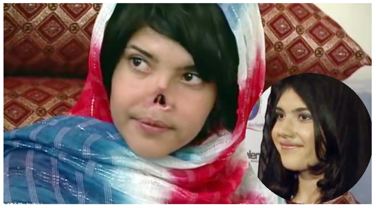 Το κορίτσι από το Αφγανιστάν που του έκοψαν τη μύτη και τα αυτιά, χαμογελάει ξανά!