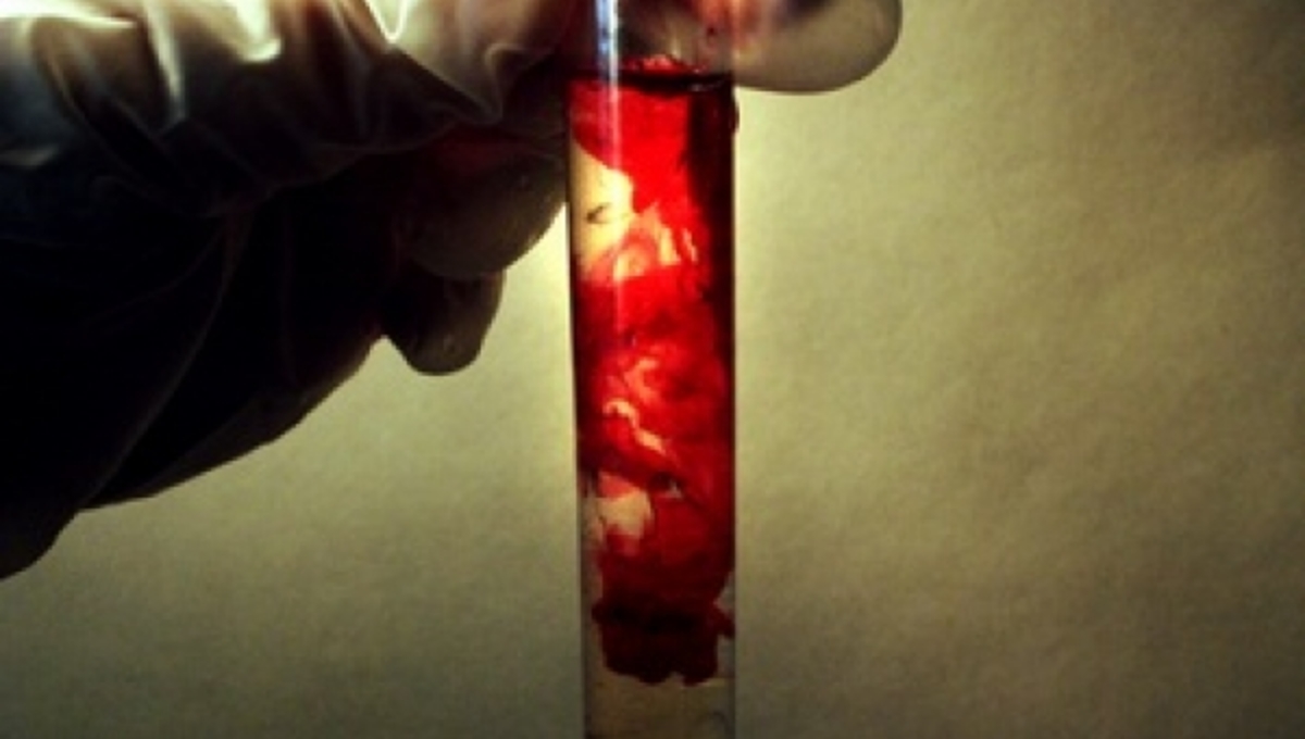 Αίμα στα ούρα; Τι πρέπει να κάνετε όταν το δείτε