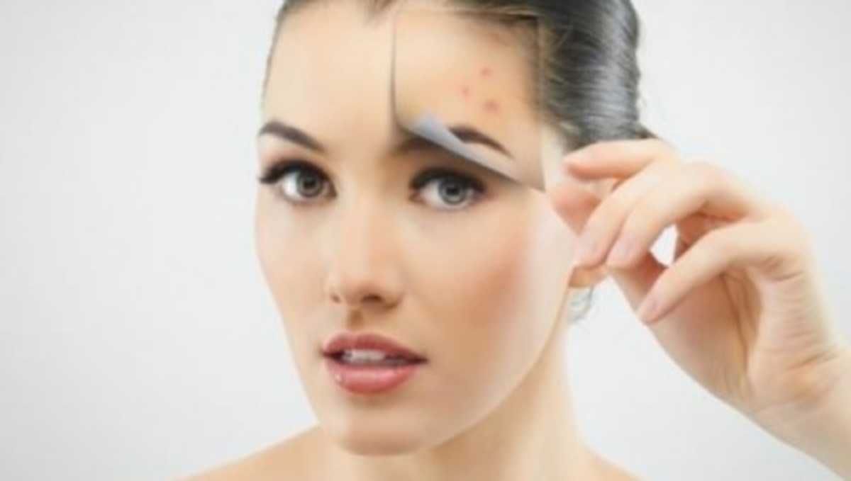 Δείτε με ποιο απλό υλικό καταπολεμάτε τα σπυράκια της ακμής – Το έχετε σίγουρα στο σπίτι