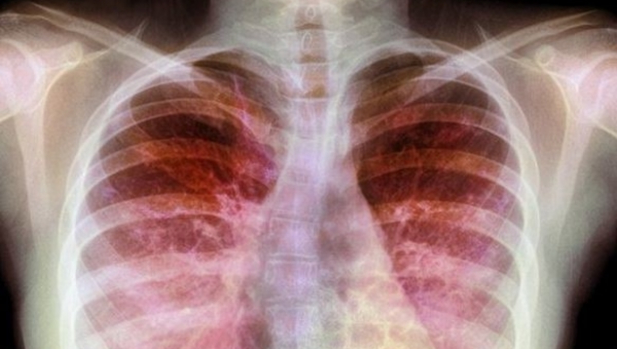 ΠΡΟΣΟΧΗ: Αν έχετε αυτά τα συμπτώματα, πάσχετε από κυστική ίνωση