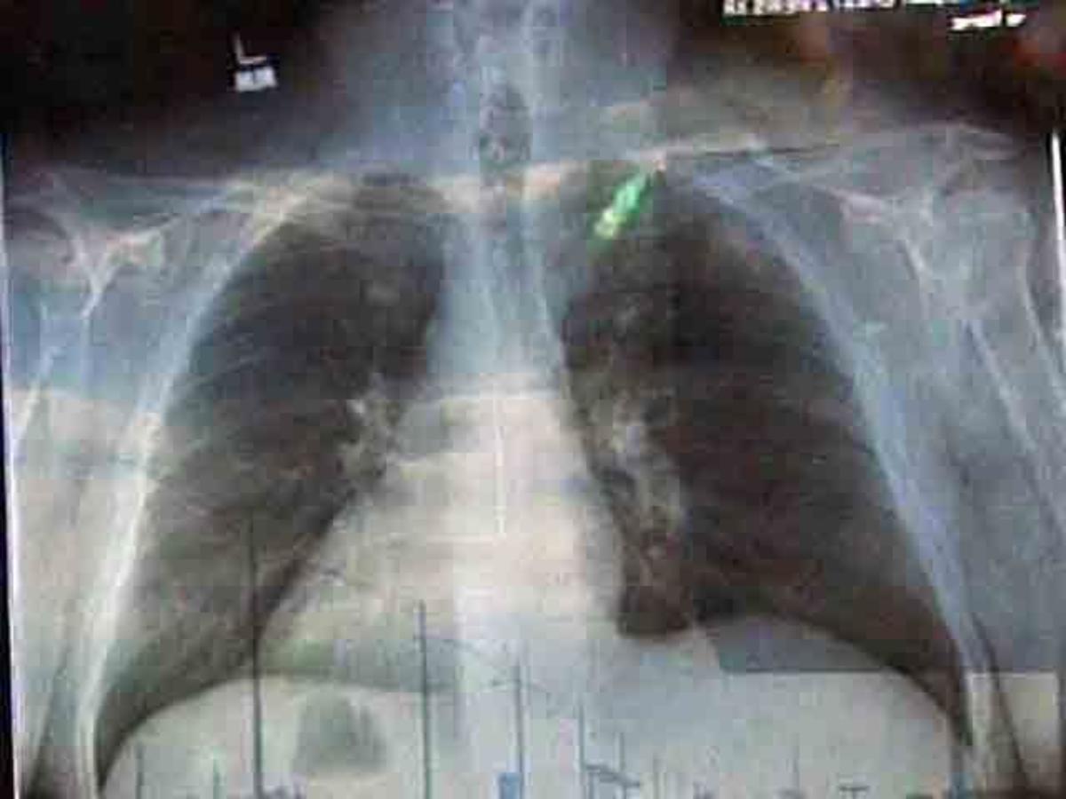 Περίπου 2,5 εκατομμύρια Έλληνες πάσχουν από κάποια ρευματική πάθηση