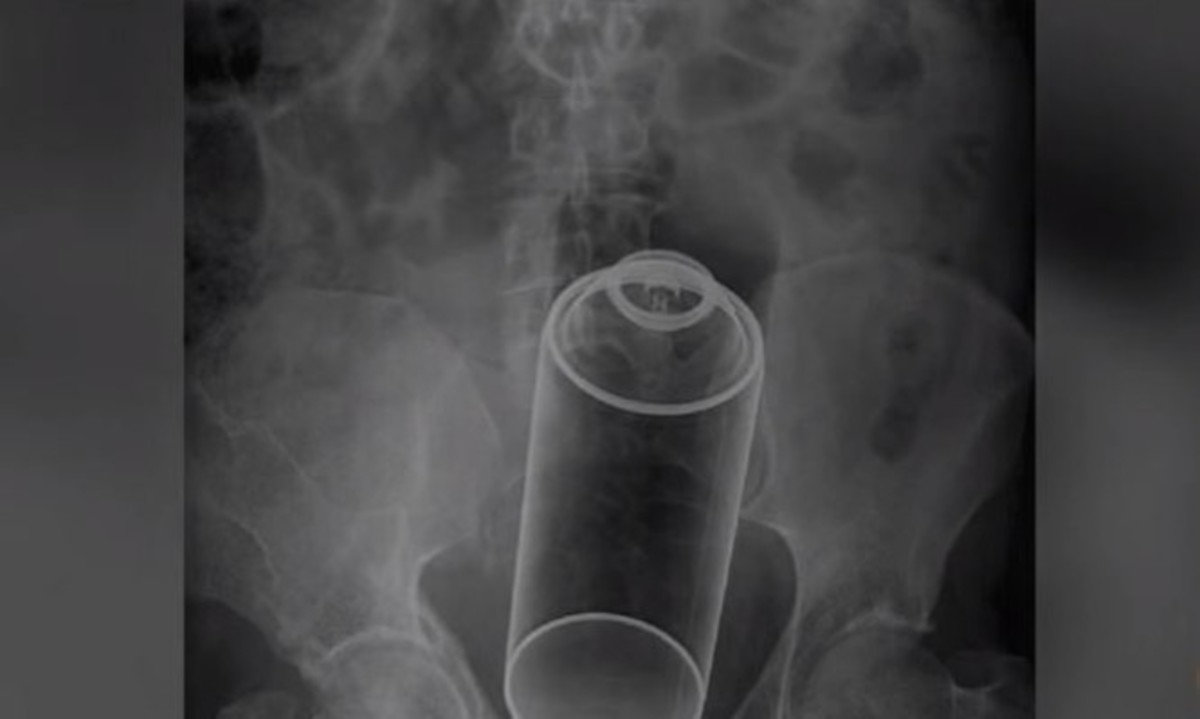 Δεν γίνονται αυτά: Οι πιο ακραίες ακτινογραφίες που είδατε ποτέ… (ΒΙΝΤΕΟ)