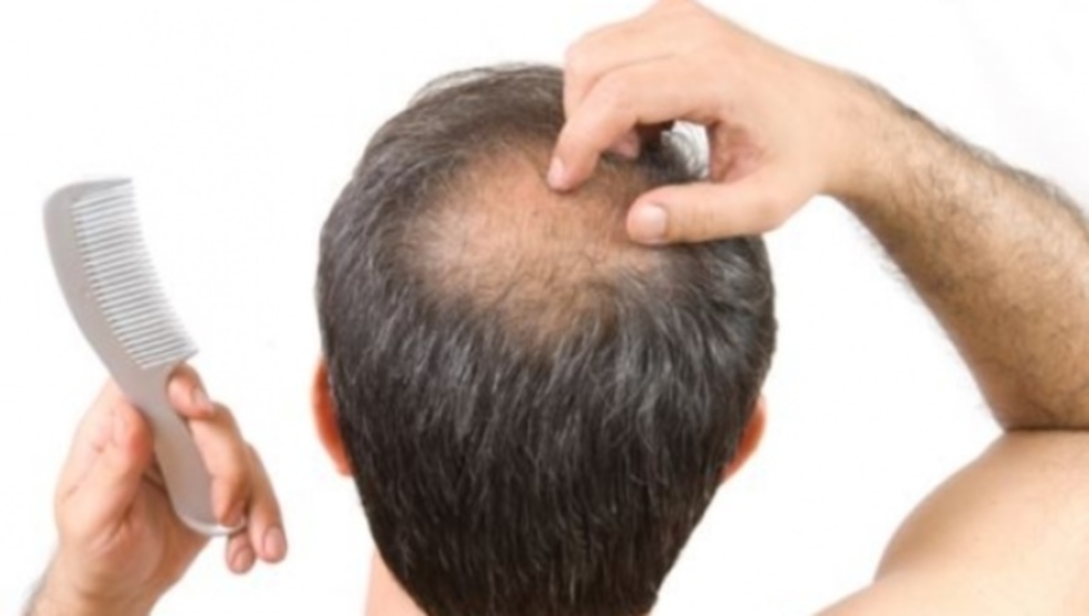 Αυτές είναι όλες οι λύσεις για την αλωπεκία – Μάθετε τα είδη και τις θεραπείες