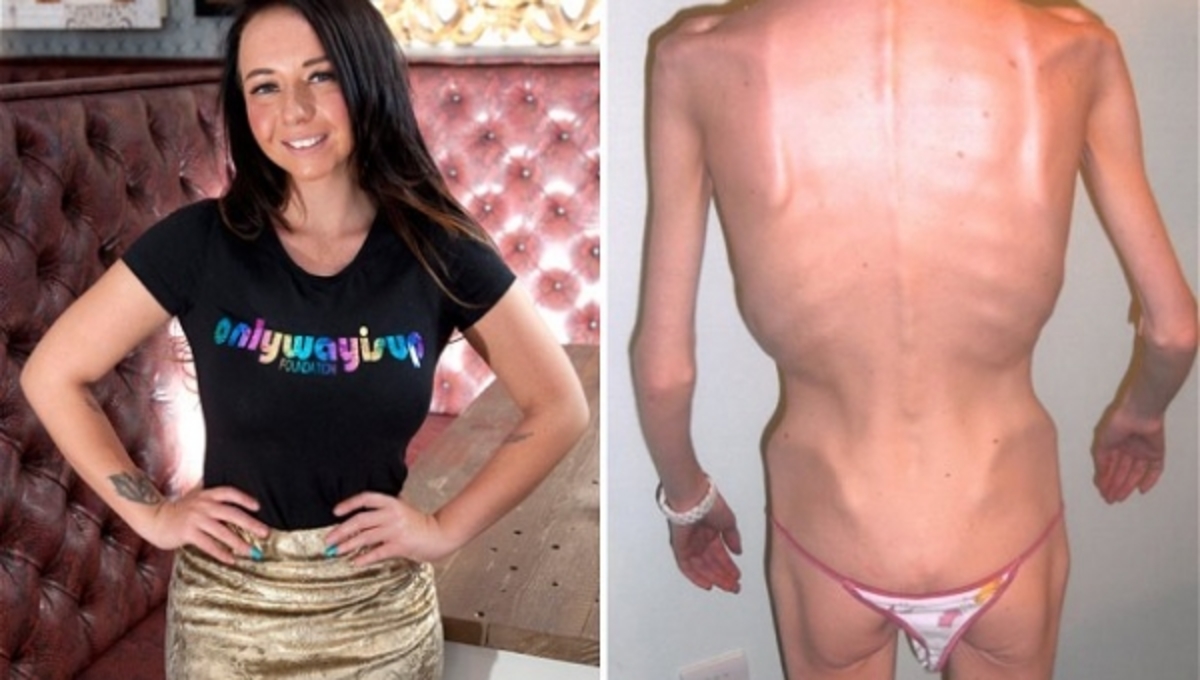 Κέρδισε τη μάχη με τη νευρική ανορεξία- ΦΩΤΟ