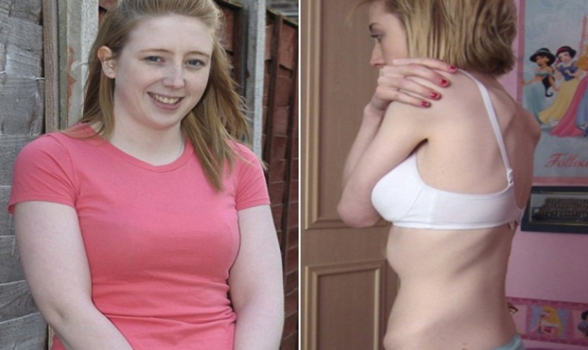 20χρονη έδωσε μάχη με την ανορεξία και αποκάλυψε: “Τα περιοδικά τροφοδότησαν το πρόβλημά μου”!