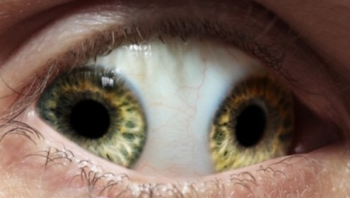 Τέτοιες εικόνες δεν έχετε ξαναδεί: Οι 10 πιο παράξενες ασθένειες στην ιστορία της ιατρικής (ΒΙΝΤΕΟ)