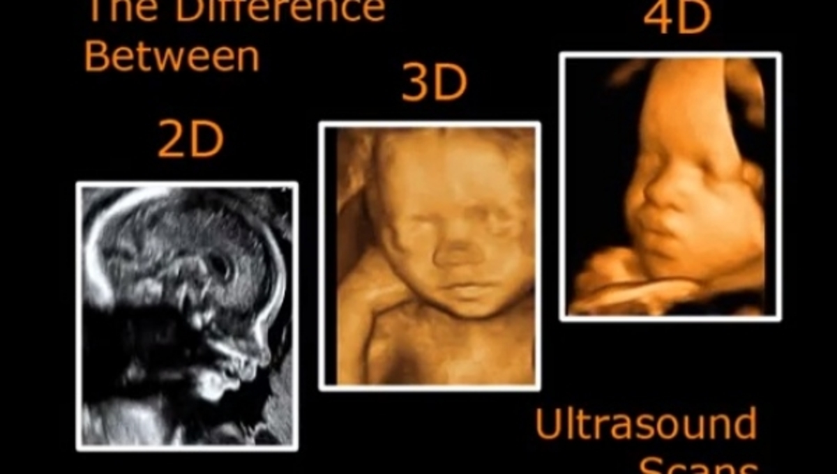 Πως φαίνεται το μωρό με υπερήχους 2, 3 και 4 διαστάσεων (ΒΙΝΤΕΟ)