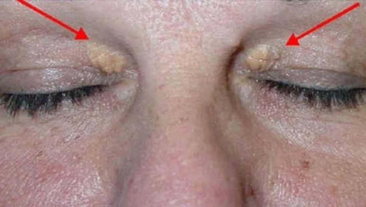 Προσοχή: Πώς συνδέονται αυτά τα σημάδια στα βλέφαρα με την πιθανότητα εμφράγματος