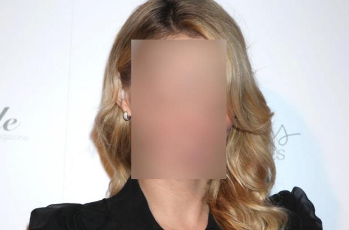 Η εξομολόγηση του πρώην μοντέλου: «Έχω μετανιώσει για τα πολλά μπότοξ»