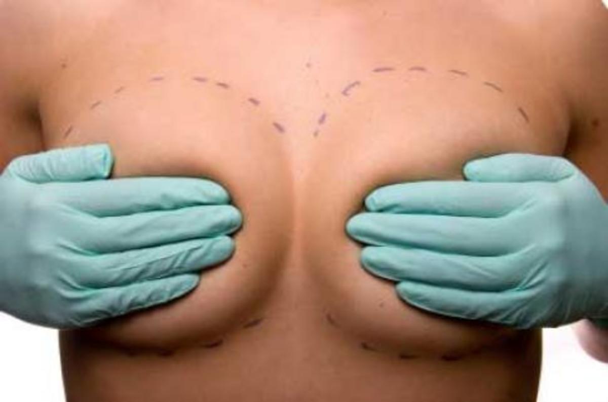 Πάνω από 12.000 γυναίκες αφαίρεσαν ελαττωματικά εμφυτεύματα στήθους