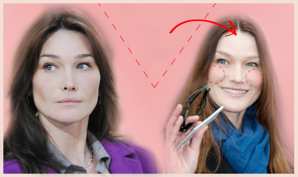 Αγνώριστη από τις αισθητικές επεμβάσεις η  C. Bruni – Τι λέει στο TLIFE γνωστός πλαστικός χειρουργός