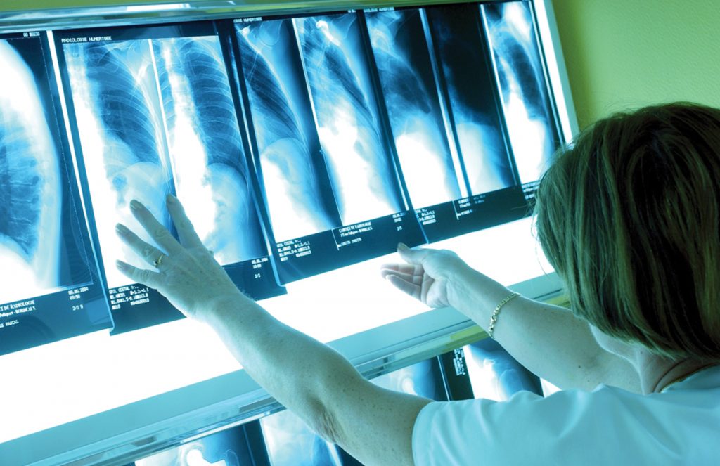 Ο καρκίνος του πνεύμονα πρώτη αιτία θανάτου παγκοσμίως!