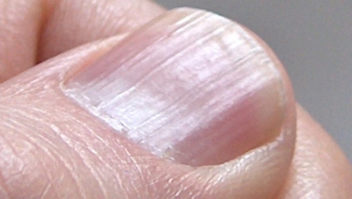 Σημάδια στα νύχια: Πότε δείχνουν πρόβλημα σε καρδιά, νεφρά και συκώτι