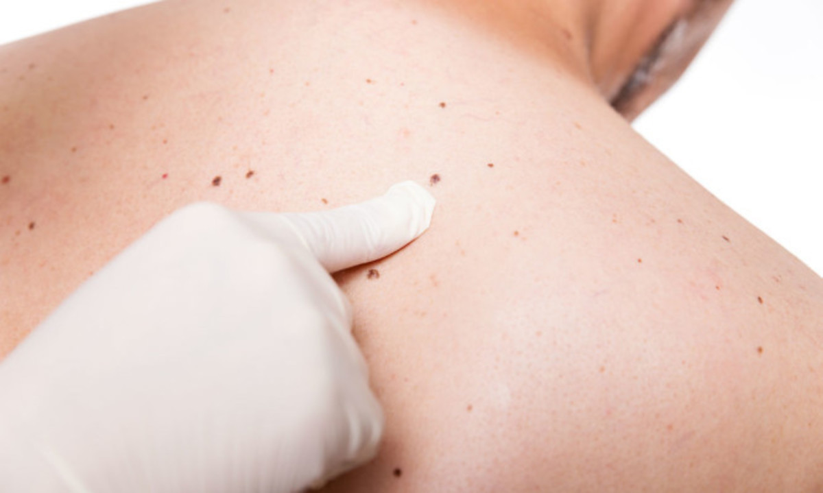 Ελιές στο δέρμα: Πώς θα καταλάβετε αν κάποια είναι καρκίνος