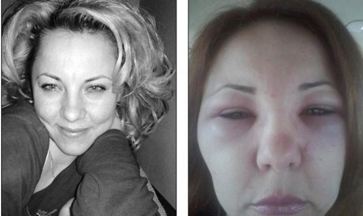 Έκανε μπότοξ με δηλητήριο οχιάς και παρέλυσε!