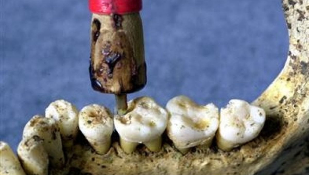 Προϊστορικοί οδοντίατροι και σφραγίσματα 6500 ετών