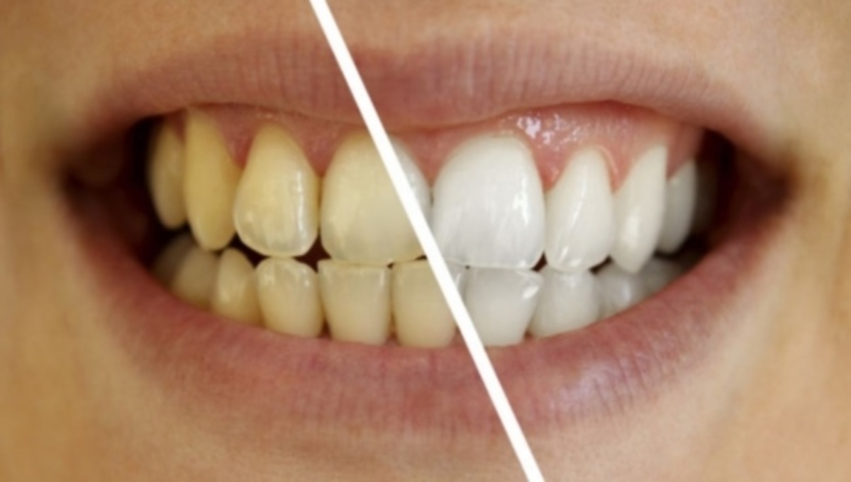 Λεύκανση δοντιών σε 3’με ένα απλό σπιτικό διάλυμα – Πώς να το φτιάξετε