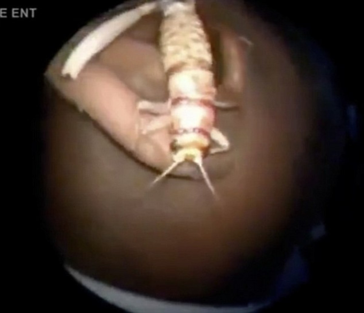 Βρήκαν στο αυτί του ζωντανό γρύλο επτά εκατοστών! ΦΩΤΟ, VIDEO