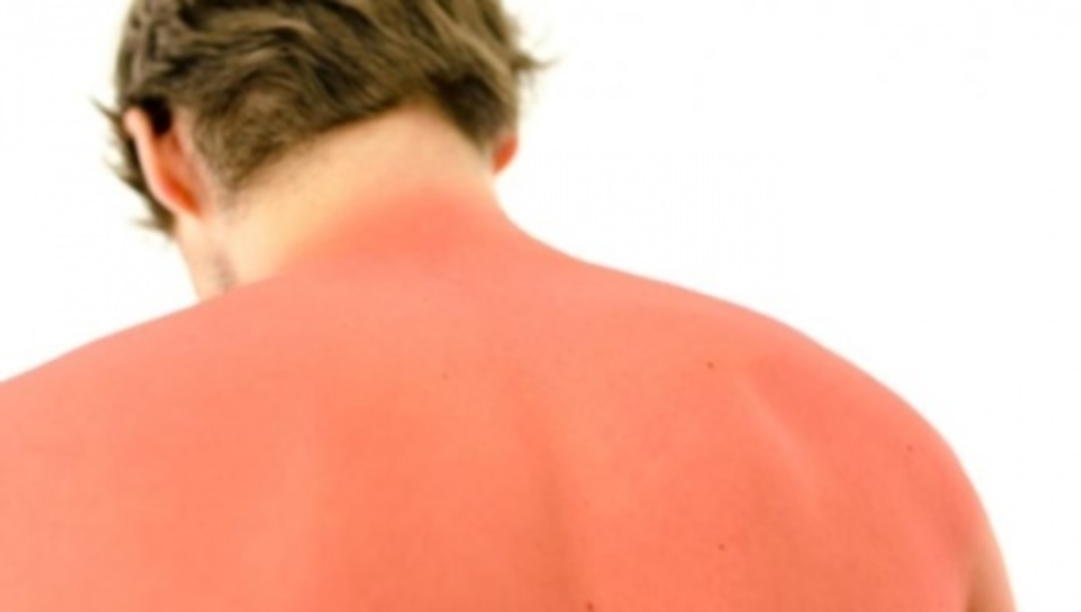 Οι Top-10 μέθοδοι αντιμετώπισης του εγκαύματος από τον ήλιο