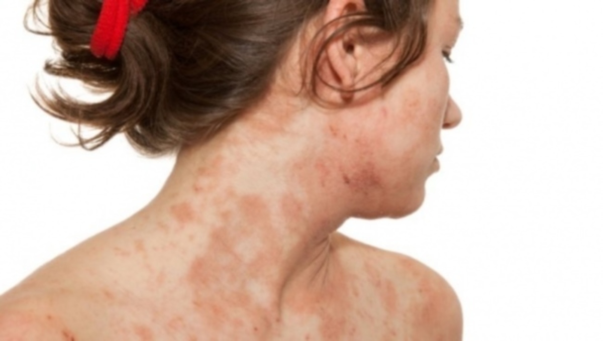 Τι είναι οι κοκκινίλες και οι ερεθισμοί στο δέρμα – Κάθε τύπος εκζέματος μέσα από εικόνες