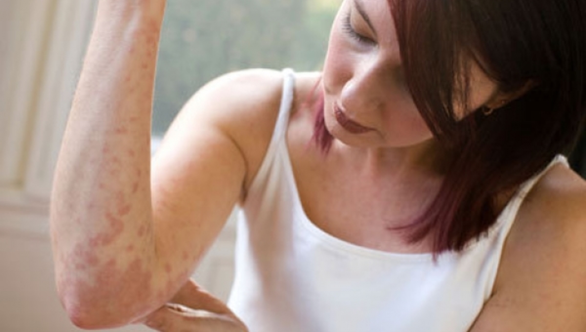 Χρήσιμες συμβουλές για να ”σβήσετε” το έκζεμα!