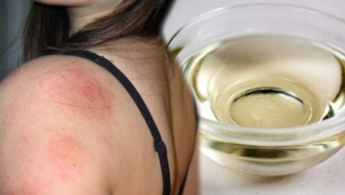 Έκζεμα και δερματίτιδα: Πώς να φτιάξετε την δική σας αλοιφή με καρυδέλαιο
