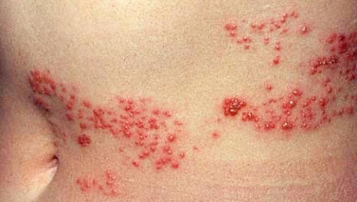 Τι να κάνετε αν δείτε συμπτώματα από τον έρπη ζωστήρα στο σώμα σας