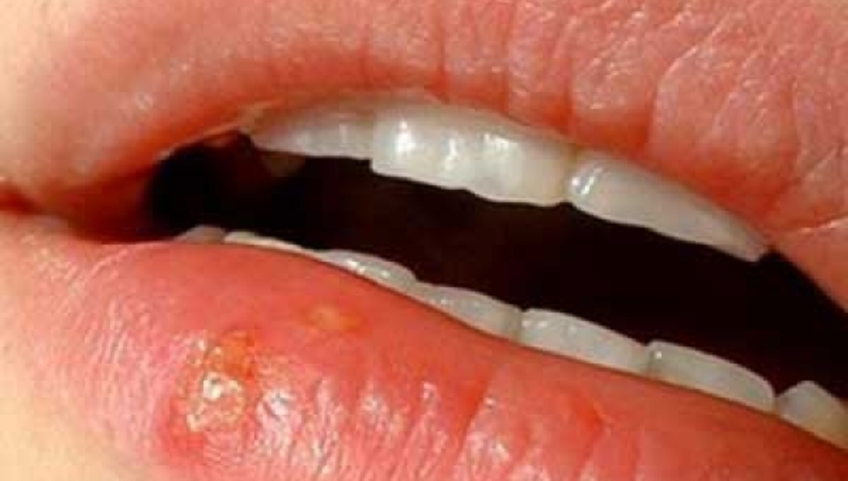 Tips για να μην ξυπνήσει ο έρπης!