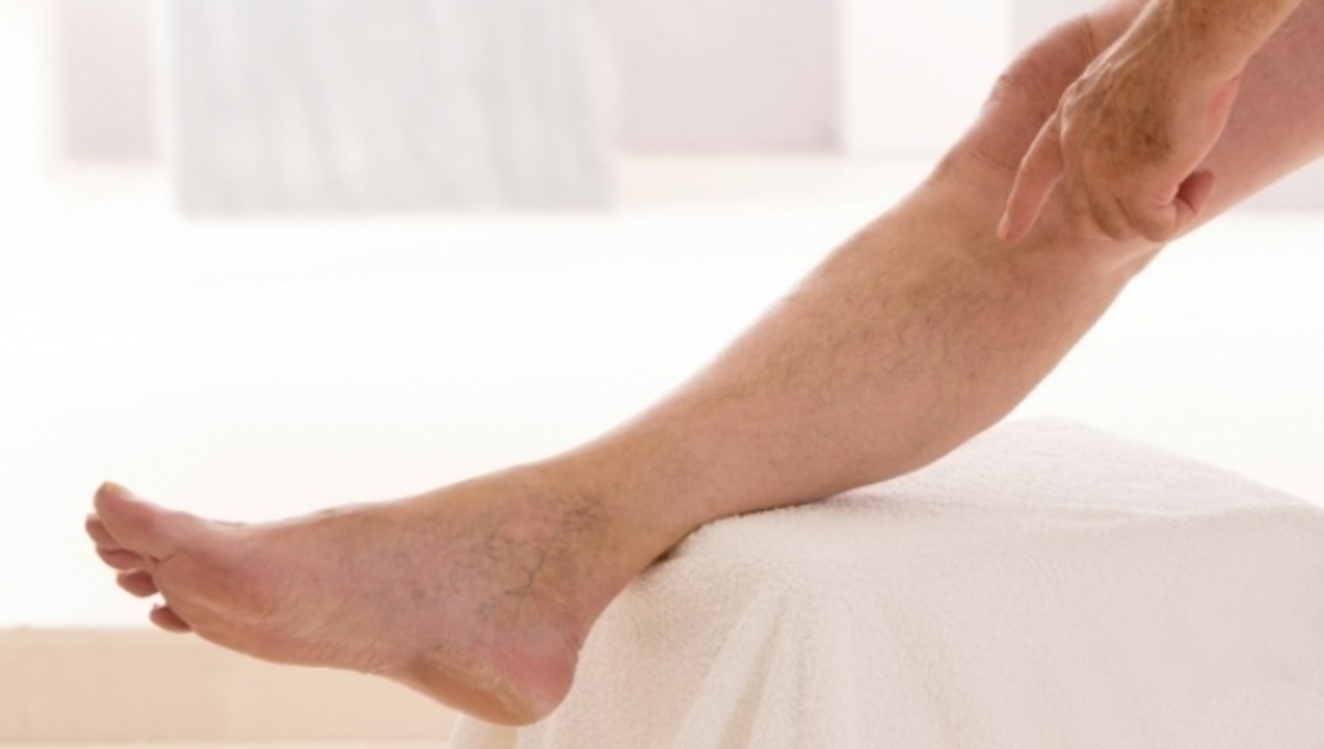 Πότε και γιατί η φλεβίτιδα στα πόδια σας χειροτερεύει