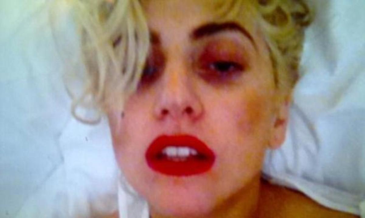 H Lady Gaga ανέβασε φωτογραφία με μαυρισμένο μάτι μετά το ατύχημα της συναυλίας!