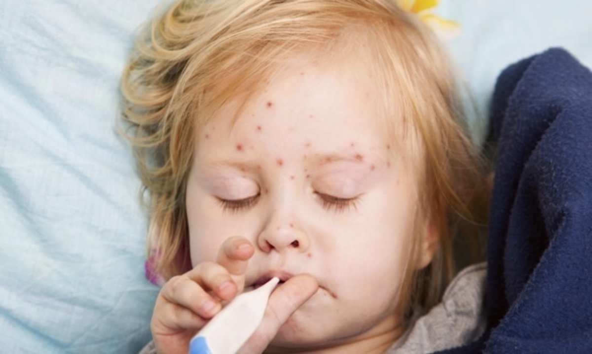 Γονείς, προσοχή: Τι πρέπει να ξέρετε για την ερυθρά στα παιδιά