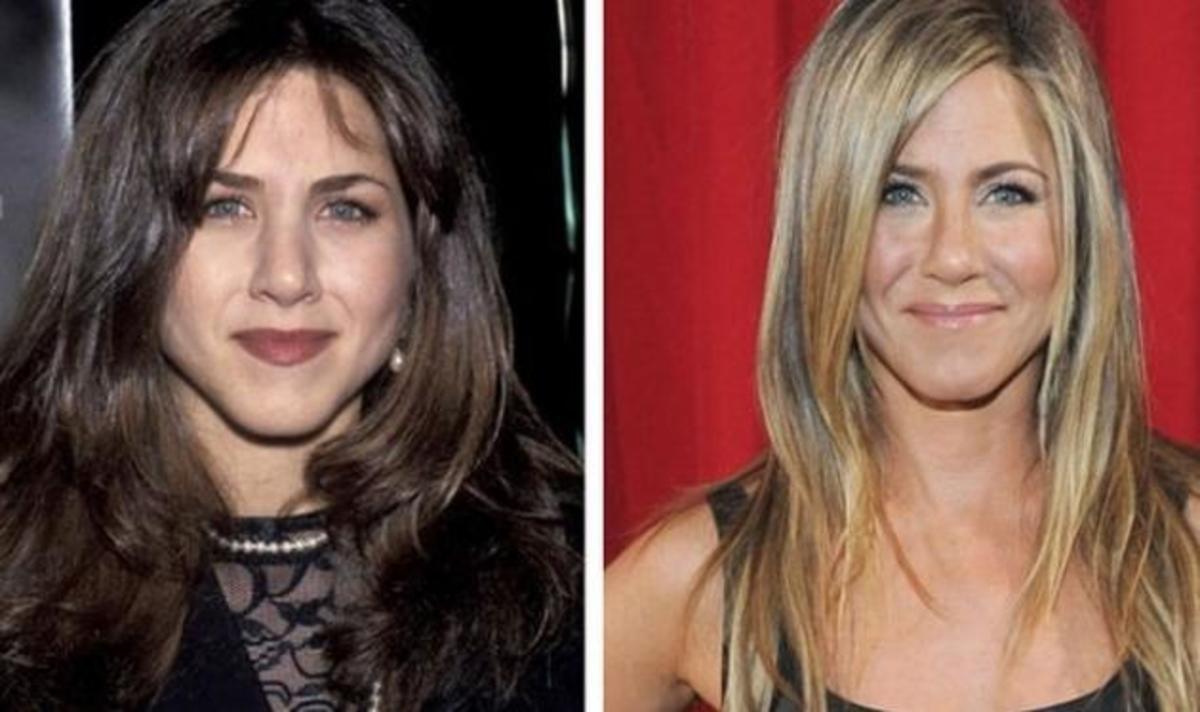 Oι celebrities του Ηollywood, πριν και μετά την πλαστική