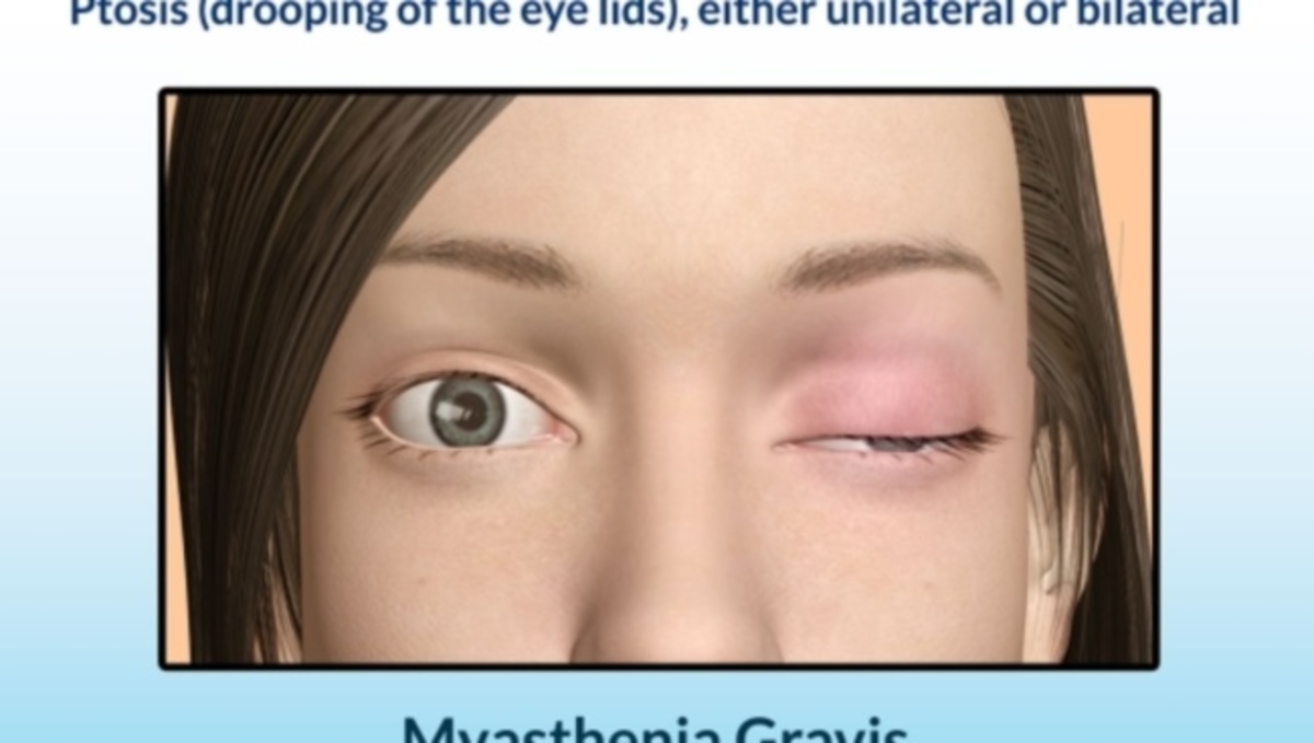 Μυασθένεια Gravis: Δείτε από τι πάσχει ο γιος της Καλομοίρας
