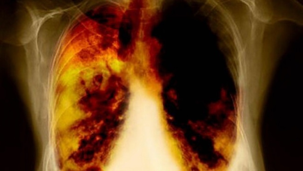 Και όμως: Μερικοί καπνιστές έχουν καθαρούς πνεύμονες – Δείτε πότε συμβαίνει αυτό