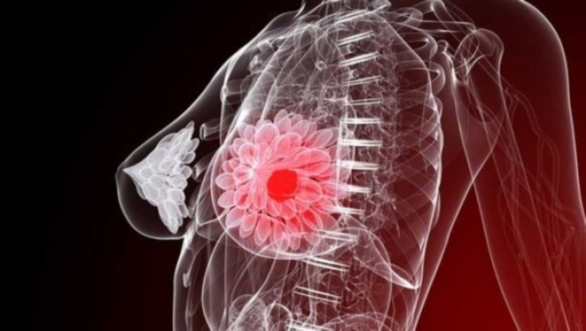 Μεγάλη ανακάλυψη για τον καρκίνο του στήθους – Τι βρήκαν οι επιστήμονες