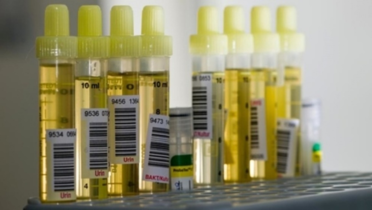 Καρκίνος στο πάγκρεας: Πότε θα εντοπίζεται με ένα απλό τεστ ούρων