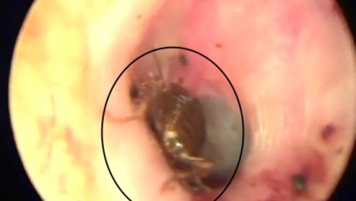 Μια κατσαρίδα ζούσε μέσα στο αυτί του – ΒΙΝΤΕΟ