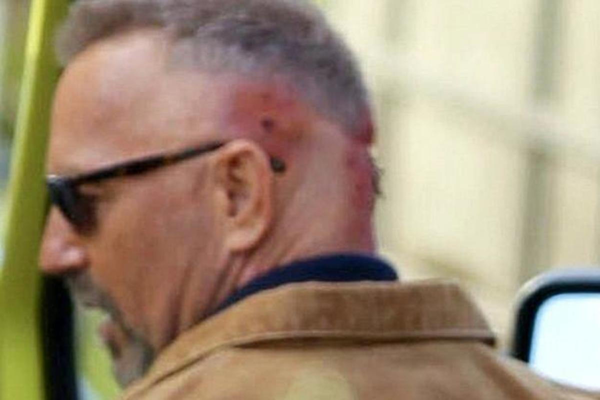 Ανατριχίλα από τα τραύματα στο κεφάλι του Kevin Costner!