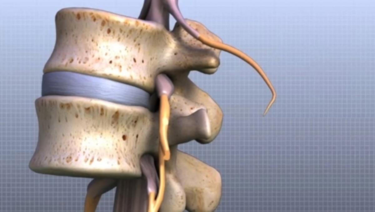 Πώς θα ξεπεράσετε την κήλη μεσοσπονδύλιου δίσκου μέσα σε 30′