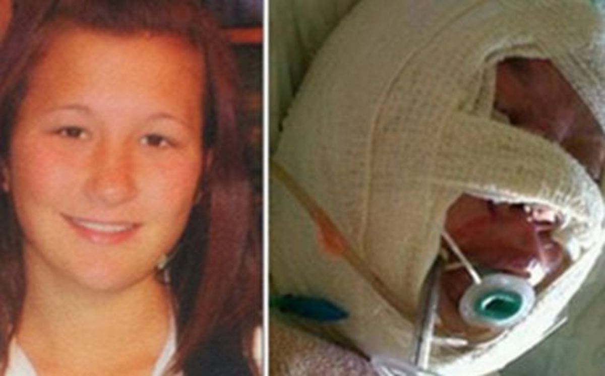 Πέθανε η 18χρονη Ελληνίδα που έκαψαν οι σατανιστές