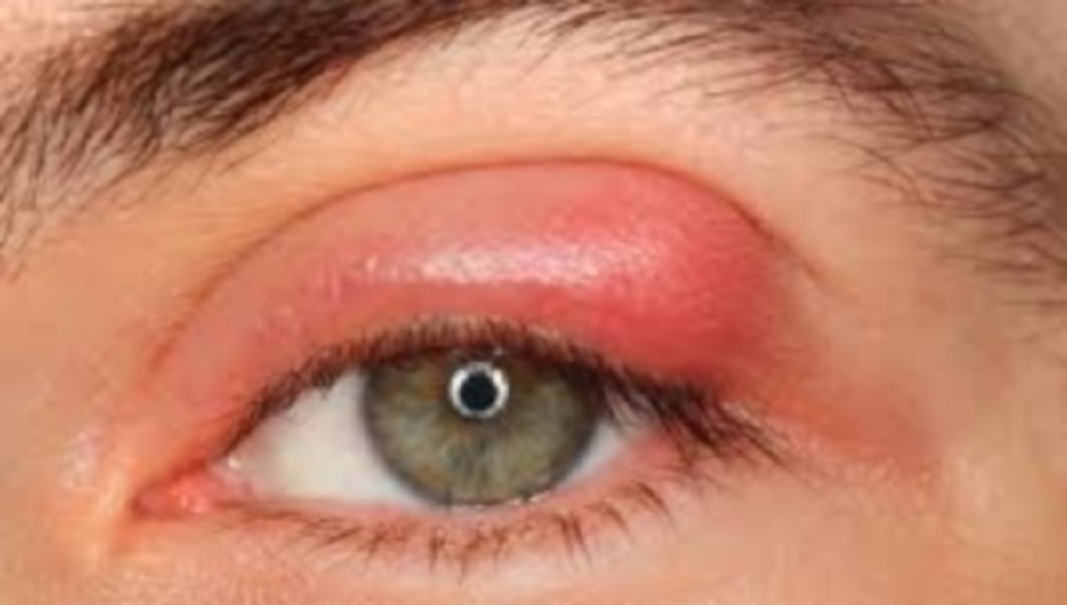 Κριθαράκι στο μάτι: Γιατί βγαίνει πάντα στο ίδιο σημείο;