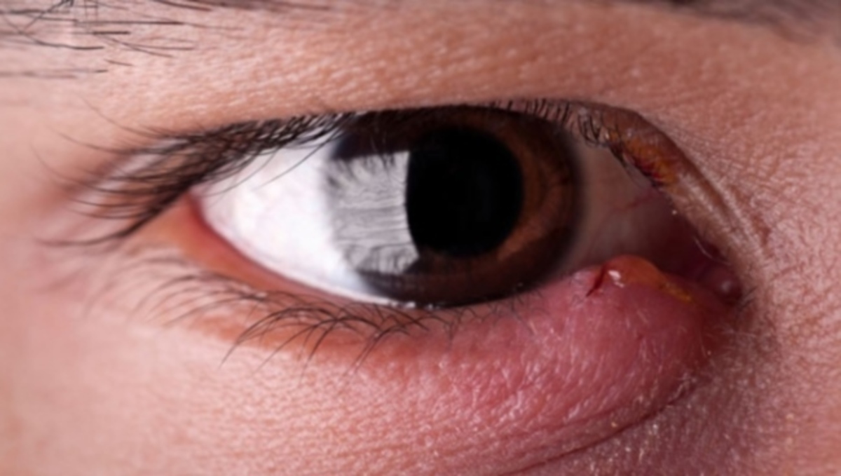 Τα σωστά βήματα για να φύγει το κριθαράκι στο μάτι