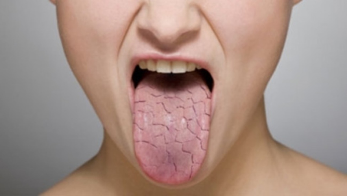 Ποιες είναι οι αιτίες της ξηροστομίας και τι να προσέξετε