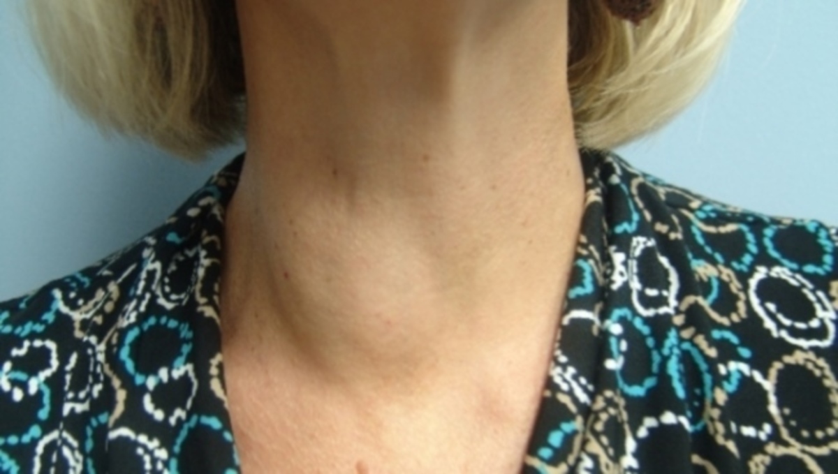 Προσοχή: Τι σημαίνει αν δείτε αυτό το πρήξιμο στον λαιμό σας