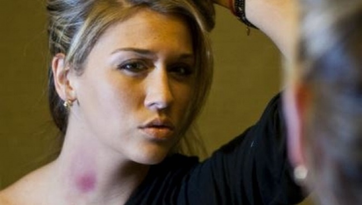 Σωτήρια λύση! Τι να κάνετε για τις… μελανιές στον λαιμό