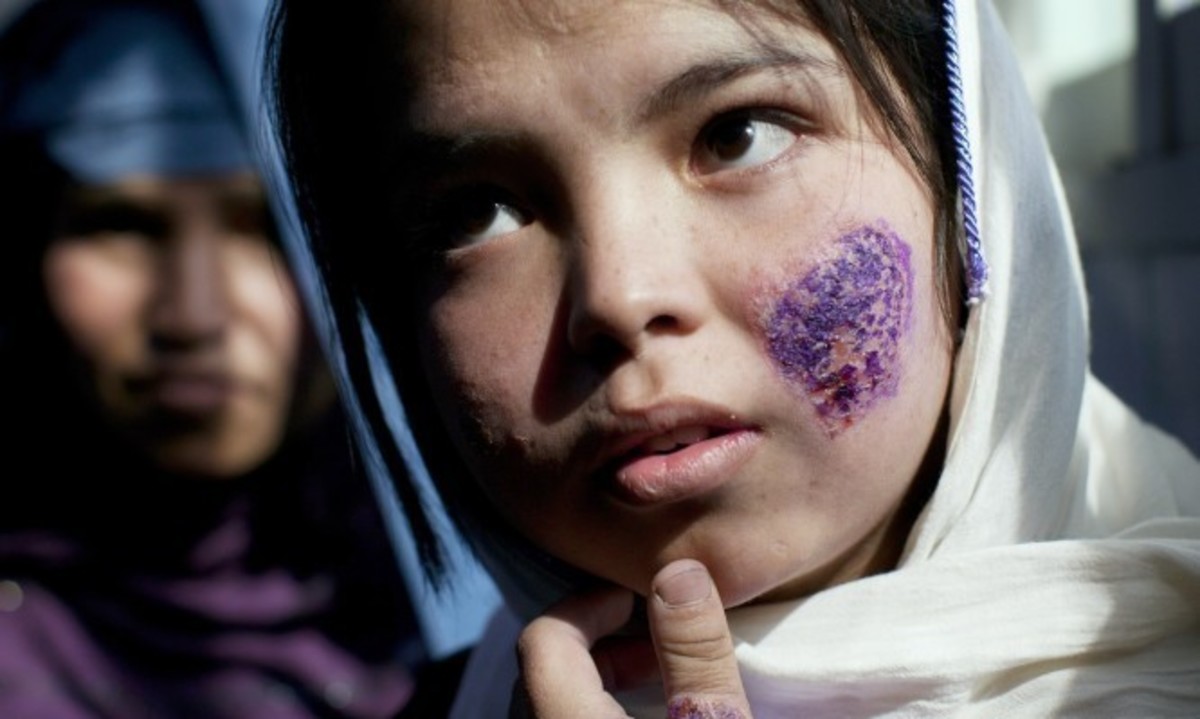 Λεϊσμανίαση: Τι είναι η τρομακτική νόσος που “τρώει την σάρκα” και θερίζει την Συρία