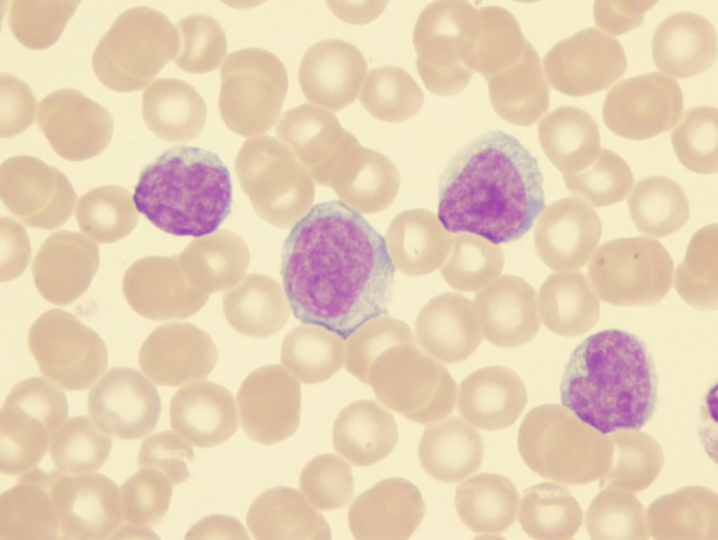 Ανακάλυψη – «σταθμός» ίσως οδηγήσει σε νέες θεραπείες κατά της λευχαιμίας