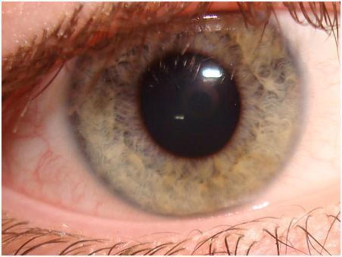 Ο αθόρυβος κλέφτης της όρασης