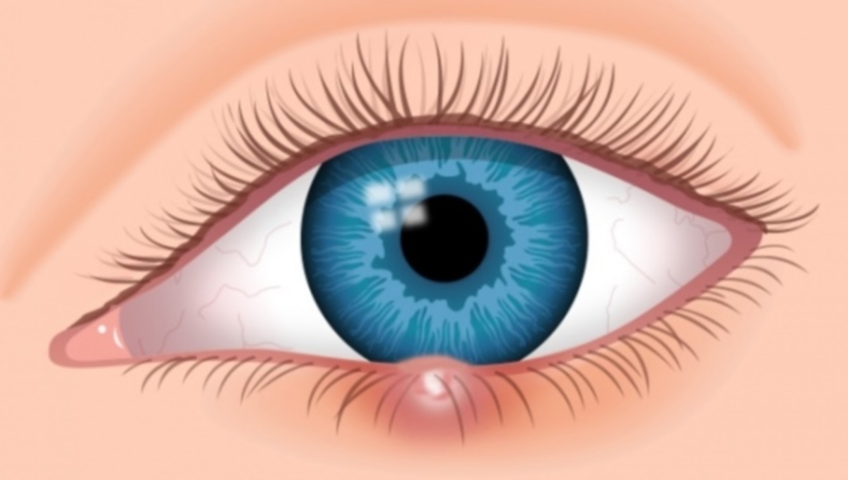 Τι να κάνετε για να φύγει γρήγορα το κριθαράκι στο μάτι – Γιατί εμφανίζεται εξ αρχής